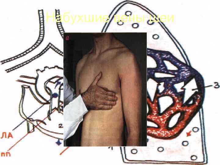 Набухшие вены шеи 