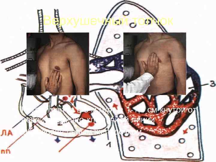   Верхушечный толчок • Локализуется в 5 -м м/р на 1 -1, 5