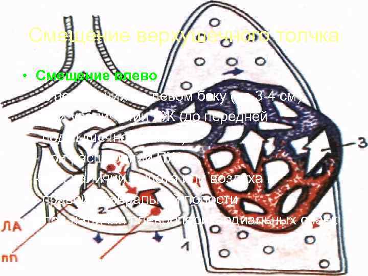 Смещение верхушечного толчка • Смещение влево  - в положении на левом боку (на