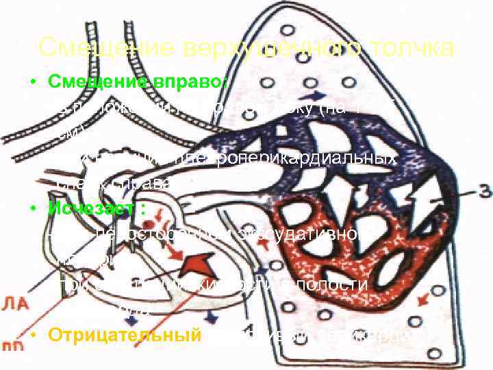 Смещение верхушечного толчка • Смещение вправо:  - в положении на правом боку (на
