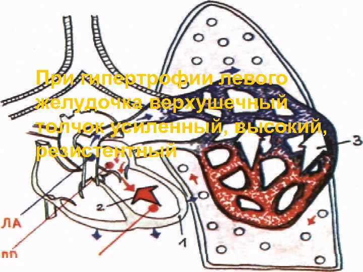При гипертрофии левого желудочка верхушечный толчок усиленный, высокий, резистентный 