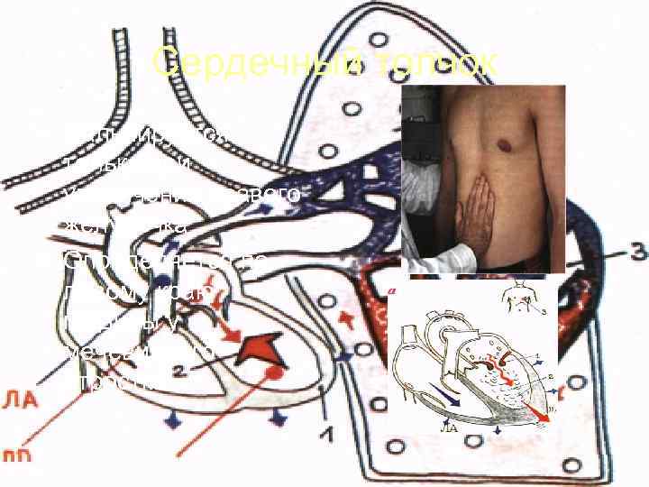   Сердечный толчок • Пальпируется  только при  увеличении правого  желудочка