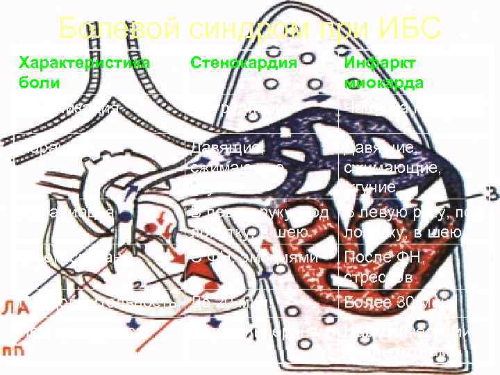   Болевой синдром при ИБС Характеристика  Стенокардия  Инфаркт боли  