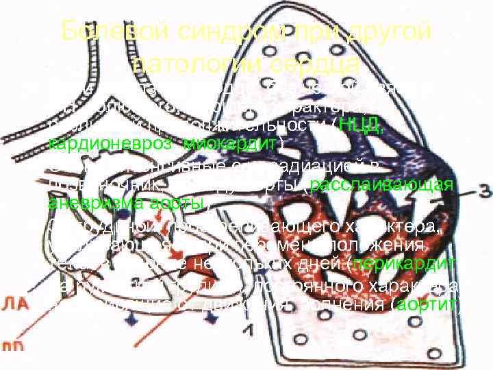   Болевой синдром при другой   патологии сердца • Боли в области