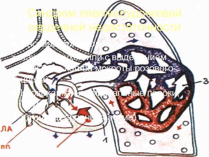   Синдром левожелудочковой  сердечной недостаточности • Инспираторная одышка • Кашель (сухой или