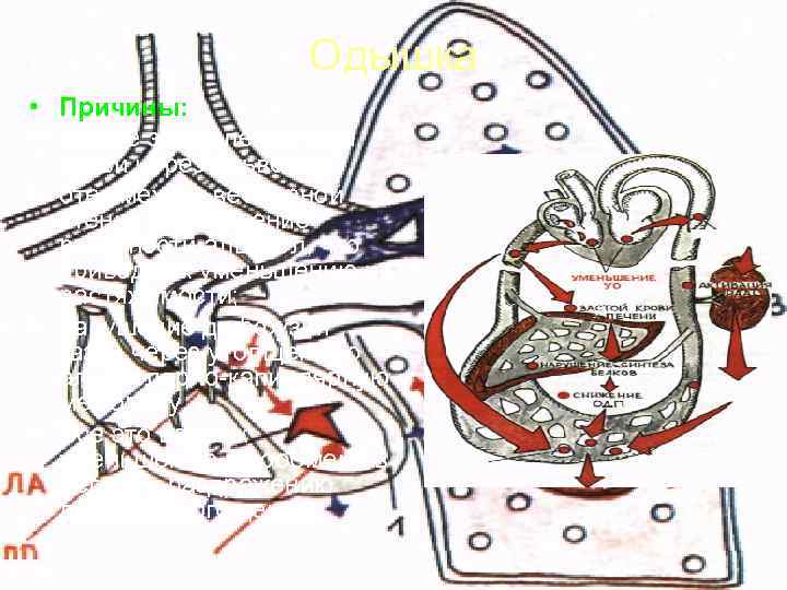     Одышка • Причины:  • резкое замедление тока  крови