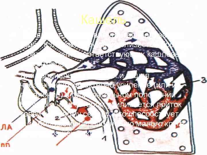   Кашель • Возникает вследствие длительного застоя  крови в легких, набухания