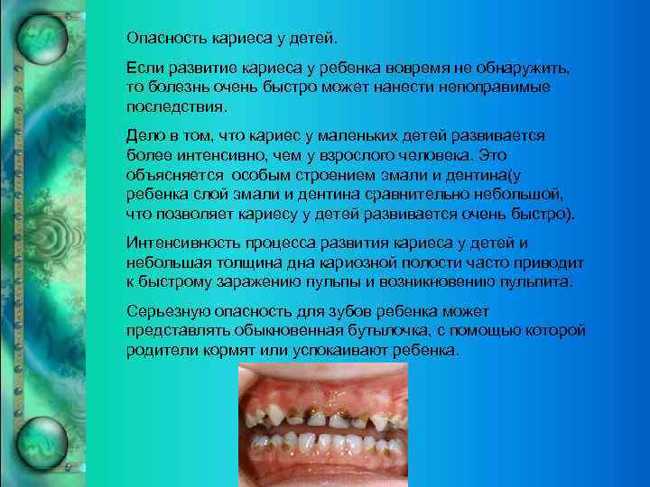    Опасность кариеса у детей.  Если развитие кариеса у ребенка вовремя