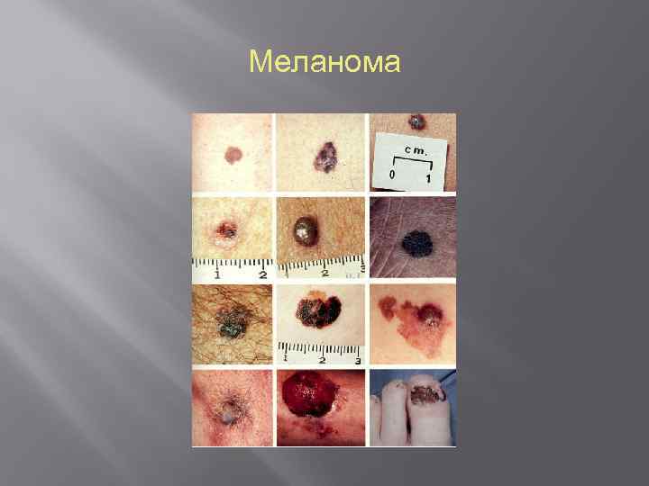 Меланома 