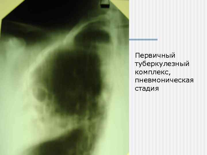 Первичный туберкулезный комплекс, пневмоническая стадия 