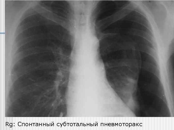 Rg: Спонтанный субтотальный пневмоторакс 