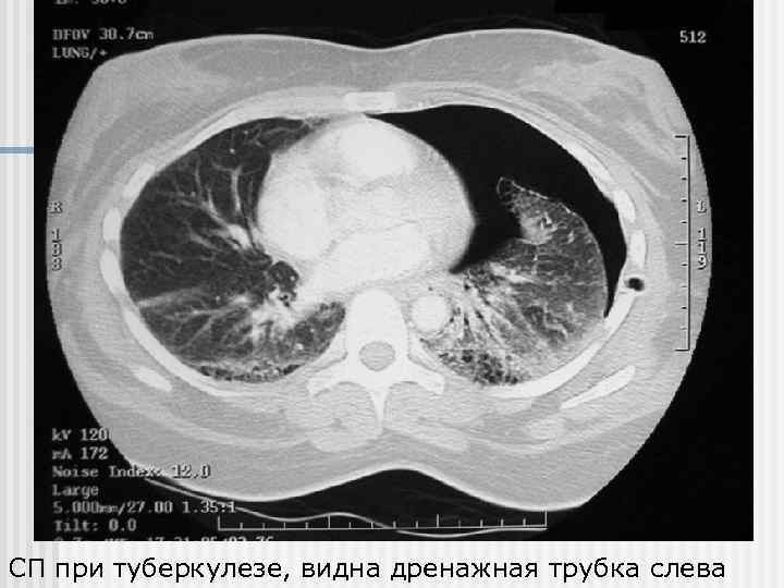 СП при туберкулезе, видна дренажная трубка слева 
