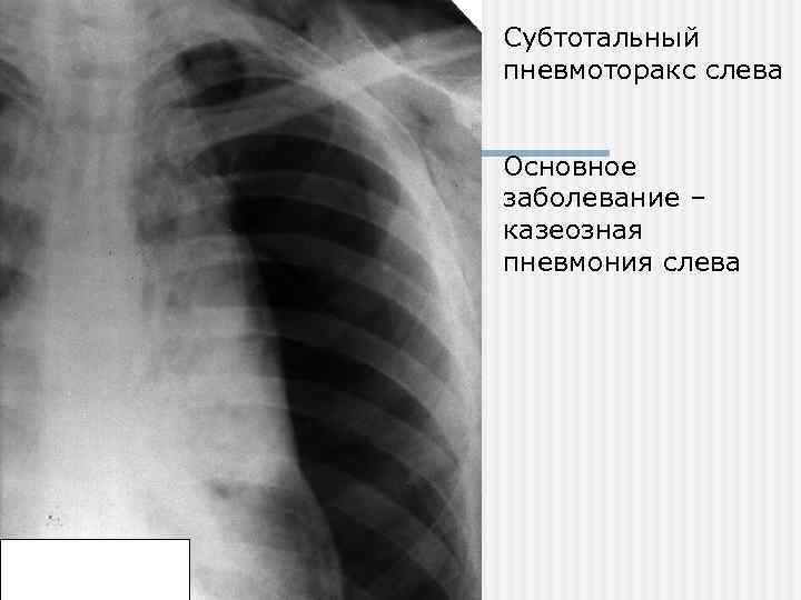 Субтотальный пневмоторакс слева Основное заболевание – казеозная пневмония слева 