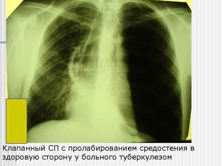 Клапанный СП с пролабированием средостения в здоровую сторону у больного туберкулезом 