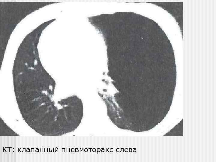 КТ: клапанный пневмоторакс слева 