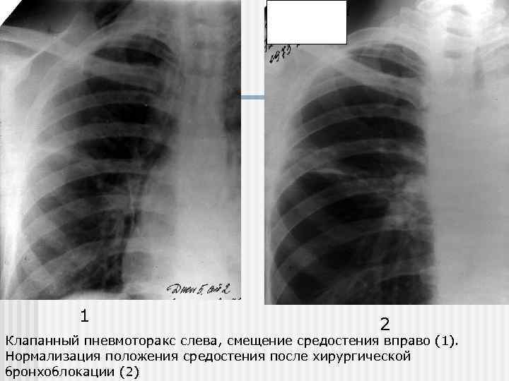 1 2 Клапанный пневмоторакс слева, смещение средостения вправо (1). Нормализация положения средостения после хирургической