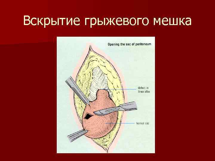 Вскрытие грыжевого мешка 