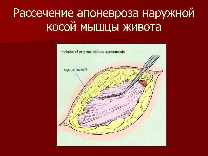 Рассечение апоневроза наружной косой мышцы живота 