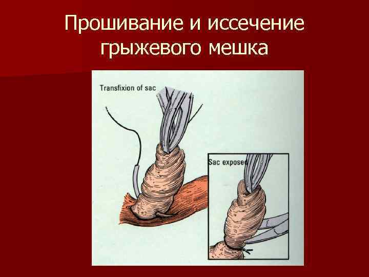 Прошивание и иссечение грыжевого мешка 