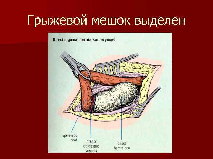 Грыжевой мешок выделен 