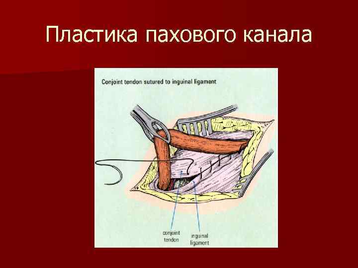 Пластика пахового канала 