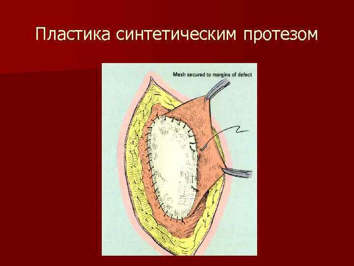 Пластика синтетическим протезом 