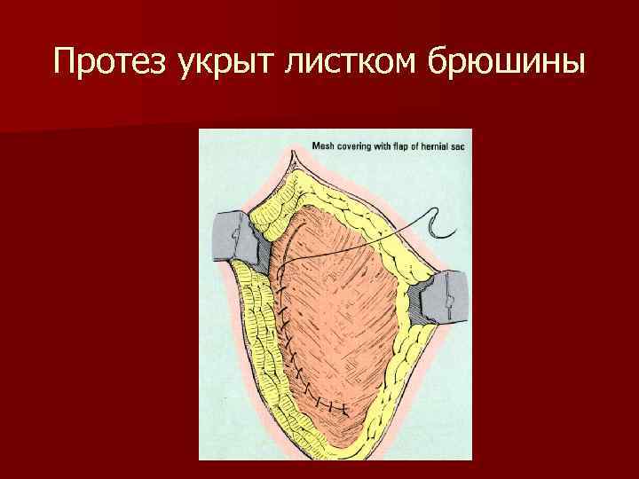 Протез укрыт листком брюшины 