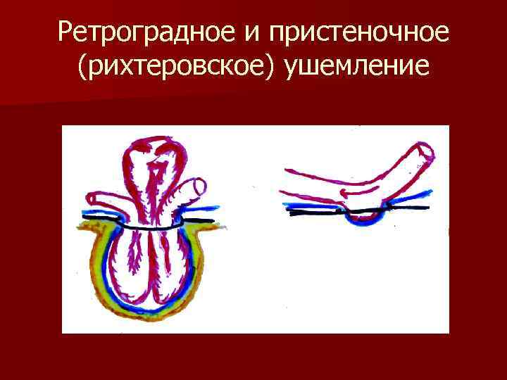 Ретроградное и пристеночное (рихтеровское) ушемление 