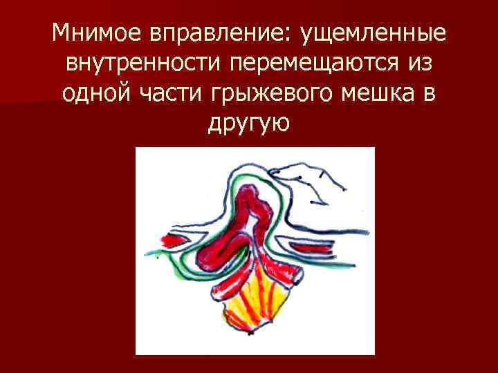 Мнимое вправление: ущемленные внутренности перемещаются из одной части грыжевого мешка в другую 