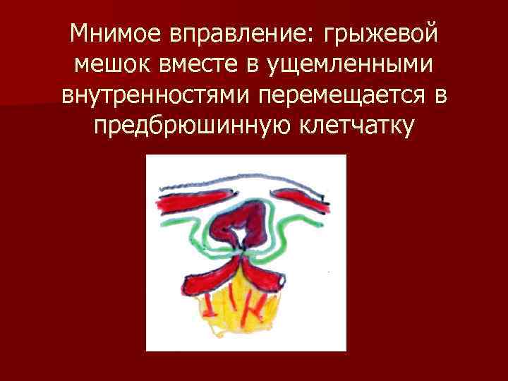 Мнимое вправление: грыжевой мешок вместе в ущемленными внутренностями перемещается в предбрюшинную клетчатку 