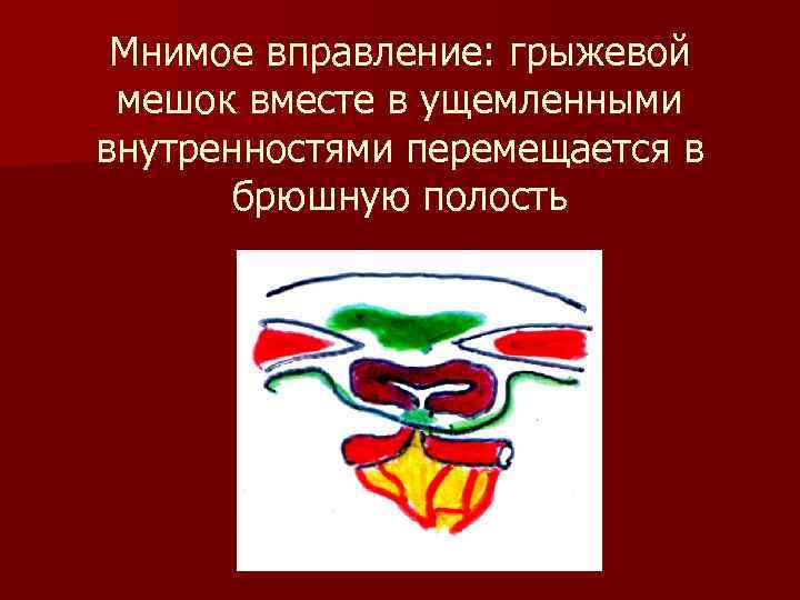 Мнимое вправление: грыжевой мешок вместе в ущемленными внутренностями перемещается в брюшную полость 