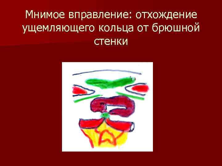 Мнимое вправление: отхождение ущемляющего кольца от брюшной стенки 