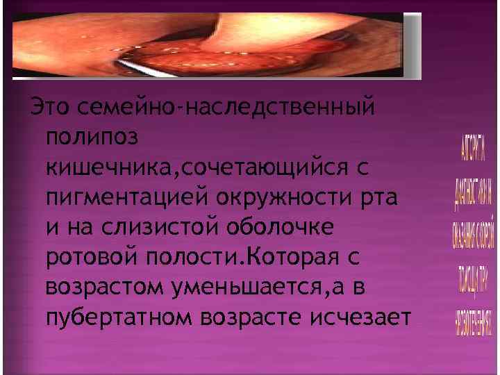Это семейно-наследственный полипоз кишечника, сочетающийся с пигментацией окружности рта и на слизистой оболочке ротовой