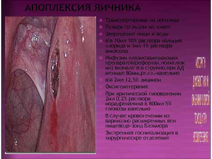   Транспортировка на носилках Пузырь со льдом на живот Запрещение пищи и воды