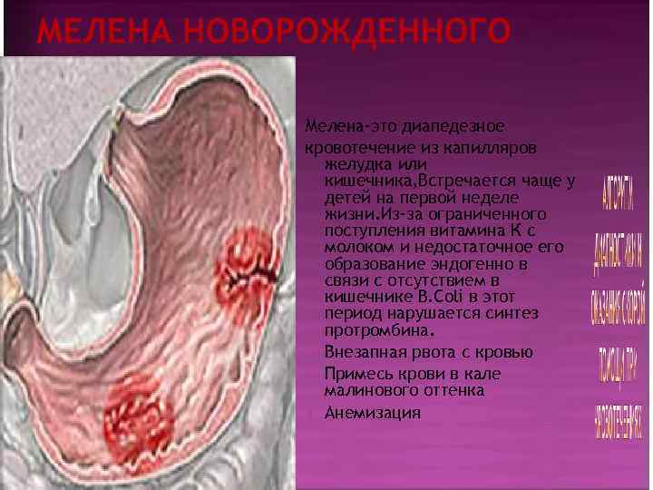 Мелена-это диапедезное кровотечение из капилляров  желудка или  кишечника, Встречается чаще у 