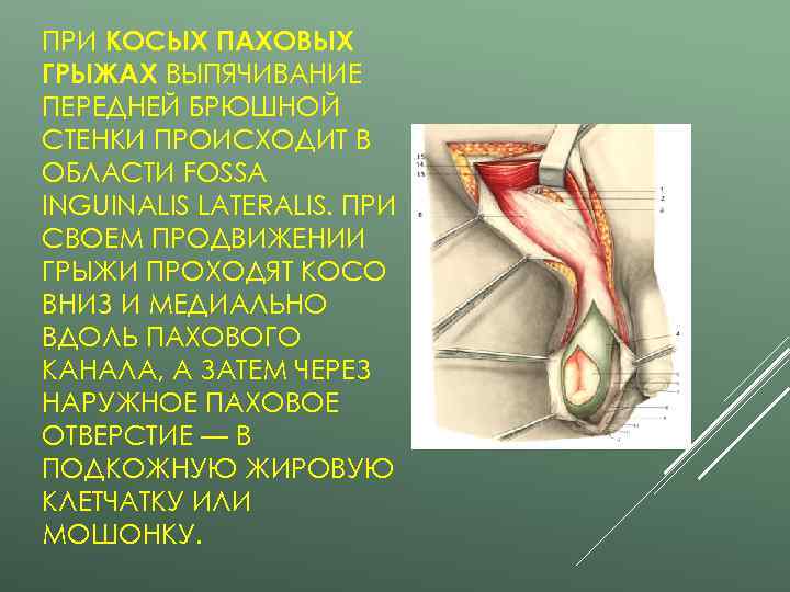 ПРИ КОСЫХ ПАХОВЫХ ГРЫЖАХ ВЫПЯЧИВАНИЕ ПЕРЕДНЕЙ БРЮШНОЙ СТЕНКИ ПРОИСХОДИТ В ОБЛАСТИ FOSSA INGUINALIS LATERALIS.
