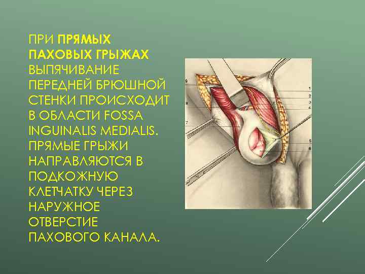 ПРИ ПРЯМЫХ ПАХОВЫХ ГРЫЖАХ ВЫПЯЧИВАНИЕ ПЕРЕДНЕЙ БРЮШНОЙ СТЕНКИ ПРОИСХОДИТ В ОБЛАСТИ FOSSA INGUINALIS MEDIALIS.