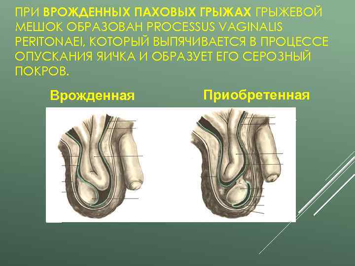 ПРИ ВРОЖДЕННЫХ ПАХОВЫХ ГРЫЖАХ ГРЫЖЕВОЙ МЕШОК ОБРАЗОВАН PROCESSUS VAGINALIS PERITONAEI, КОТОРЫЙ ВЫПЯЧИВАЕТСЯ В ПРОЦЕССЕ
