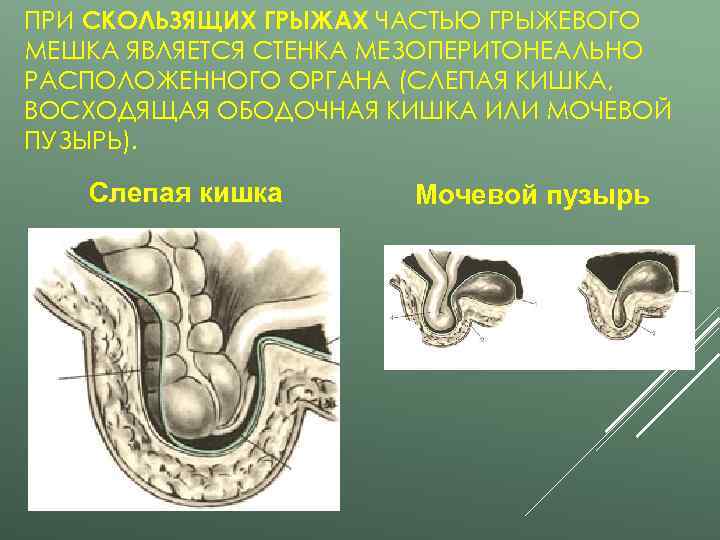 ПРИ СКОЛЬЗЯЩИХ ГРЫЖАХ ЧАСТЬЮ ГРЫЖЕВОГО МЕШКА ЯВЛЯЕТСЯ СТЕНКА МЕЗОПЕРИТОНЕАЛЬНО РАСПОЛОЖЕННОГО ОРГАНА (СЛЕПАЯ КИШКА, ВОСХОДЯЩАЯ