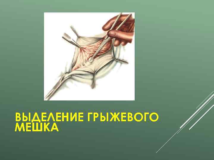 ВЫДЕЛЕНИЕ ГРЫЖЕВОГО МЕШКА 