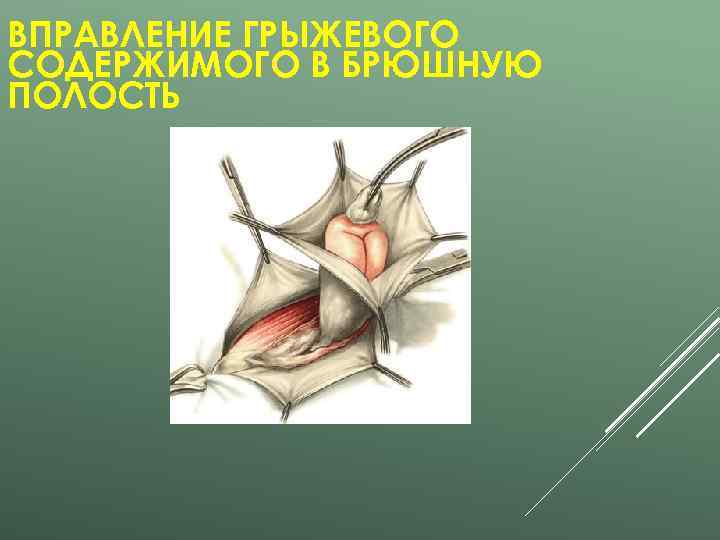 ВПРАВЛЕНИЕ ГРЫЖЕВОГО СОДЕРЖИМОГО В БРЮШНУЮ ПОЛОСТЬ 