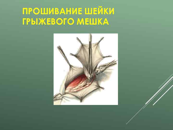 ПРОШИВАНИЕ ШЕЙКИ ГРЫЖЕВОГО МЕШКА 