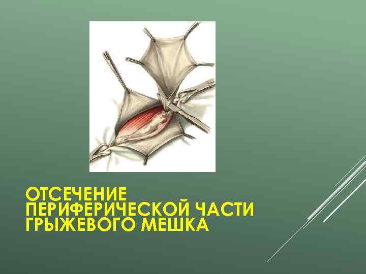 ОТСЕЧЕНИЕ ПЕРИФЕРИЧЕСКОЙ ЧАСТИ ГРЫЖЕВОГО МЕШКА 