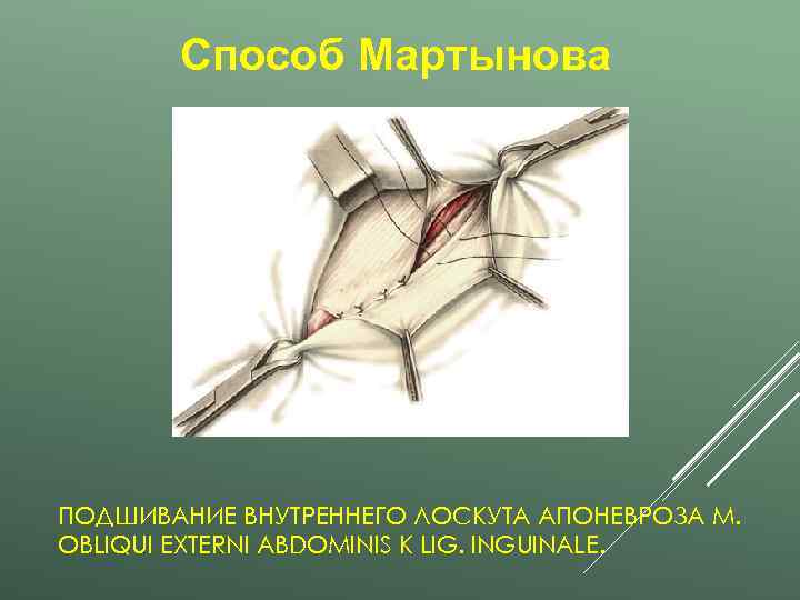   Способ Мартынова ПОДШИВАНИЕ ВНУТРЕННЕГО ЛОСКУТА АПОНЕВРОЗА M. OBLIQUI EXTERNI ABDOMINIS K LIG.