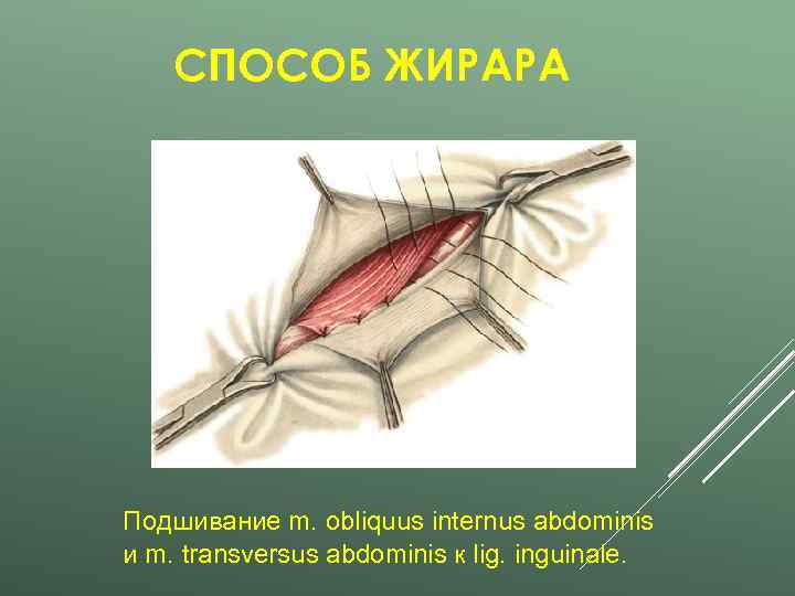   СПОСОБ ЖИРАРА Подшивание m. obliquus internus abdominis и m. transversus abdominis к