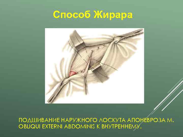    Способ Жирара ПОДШИВАНИЕ НАРУЖНОГО ЛОСКУТА АПОНЕВРОЗА M. OBLIQUI EXTERNI ABDOMINIS К