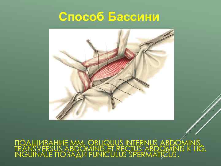   Способ Бассини ПОДШИВАНИЕ MM. OBLIQUUS INTERNUS ABDOMINIS, TRANSVERSUS ABDOMINIS ET RECTUS ABDOMINIS