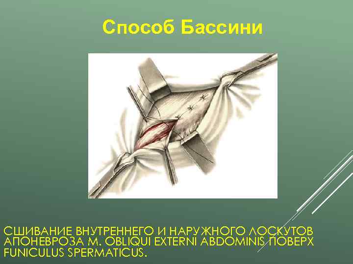    Способ Бассини СШИВАНИЕ ВНУТРЕННЕГО И НАРУЖНОГО ЛОСКУТОВ АПОНЕВРОЗА M. OBLIQUI EXTERNI