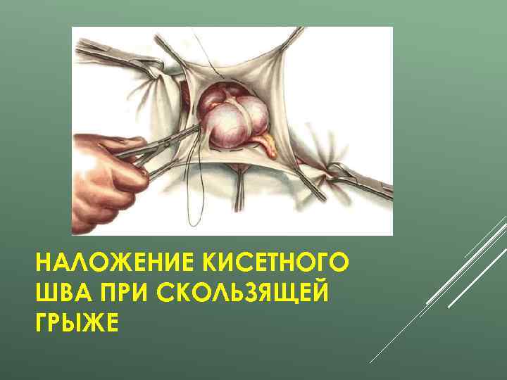 НАЛОЖЕНИЕ КИСЕТНОГО ШВА ПРИ СКОЛЬЗЯЩЕЙ ГРЫЖЕ 