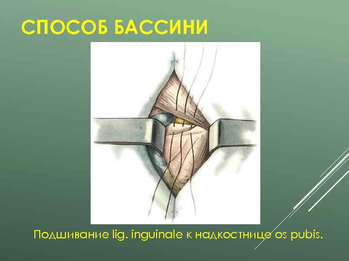 СПОСОБ БАССИНИ Подшивание lig. inguinale к надкостнице os pubis. 